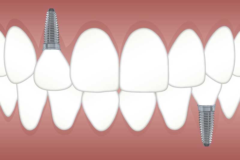 implant dentaire temoignage prix